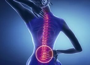 juosmens osteochondrozės apraiškos
